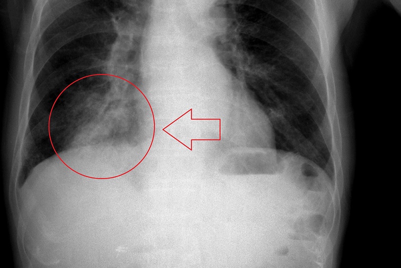 X-ray of diseased lung