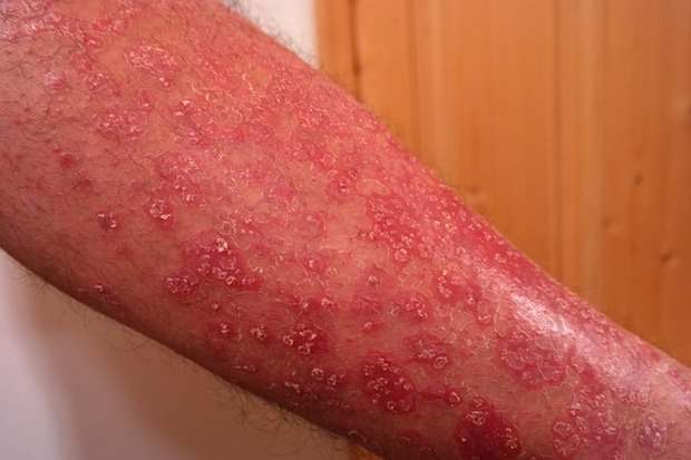 psoriasis rash on a person’s leg