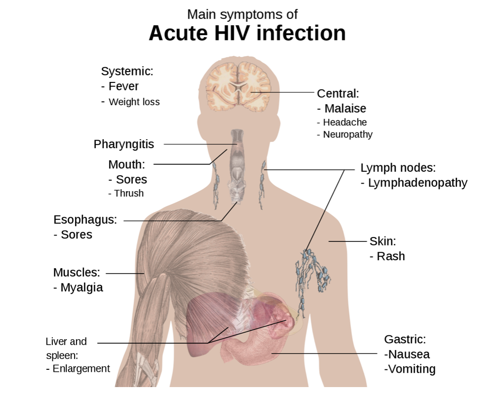 a diagram displaying the symptoms of acute HIV infection