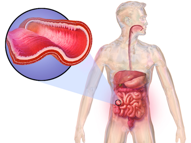 a diagram showing intestinal inflammation