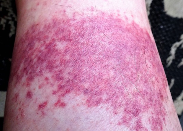 a splotchy rash of vasculitis on a person’s leg